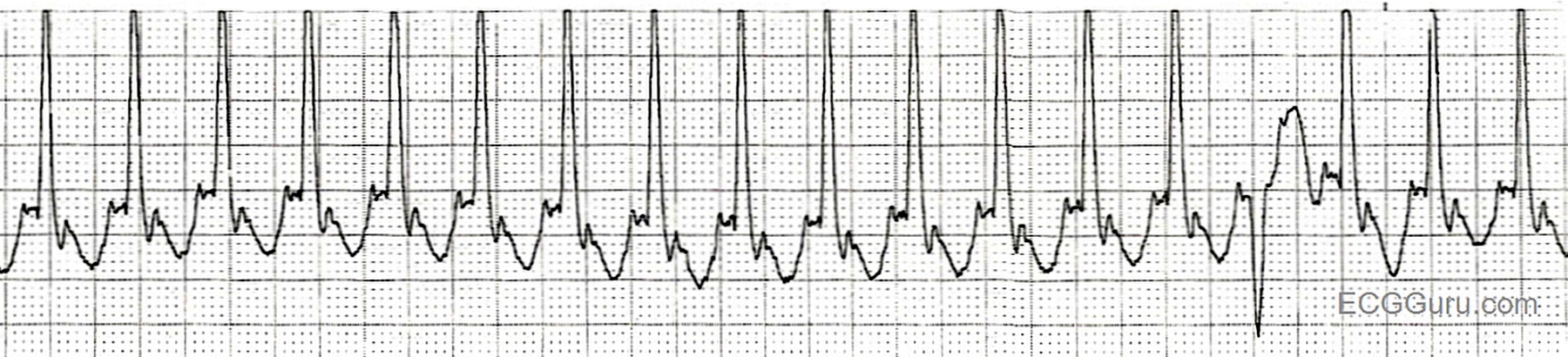 ecg-basics-atrial-flutter-with-2-1-conduction-and-an-aberrantly